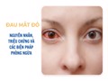 Tìm hiểu bệnh đau mắt đỏ và biện pháp phòng ngừa bệnh